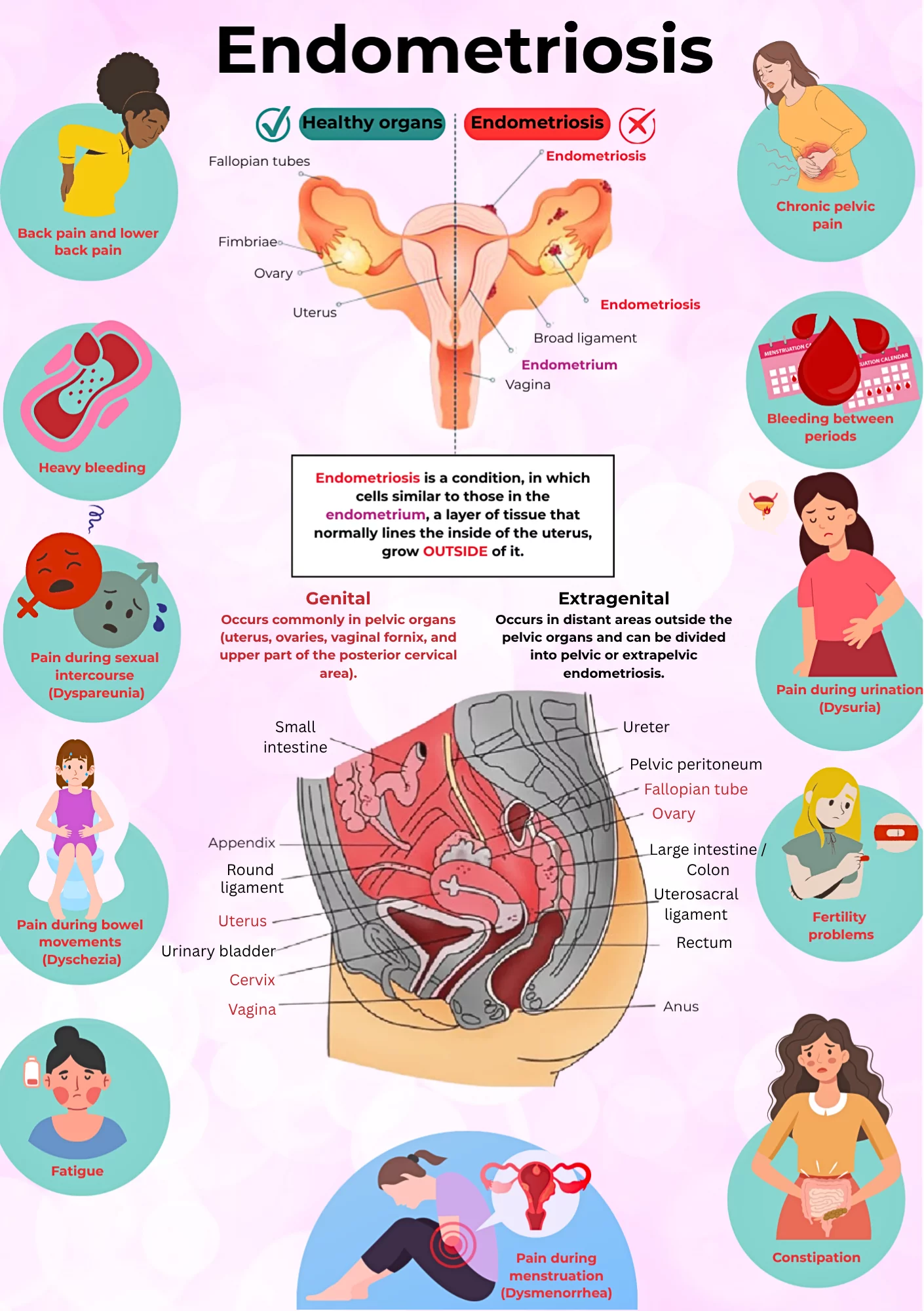 endrometriosis