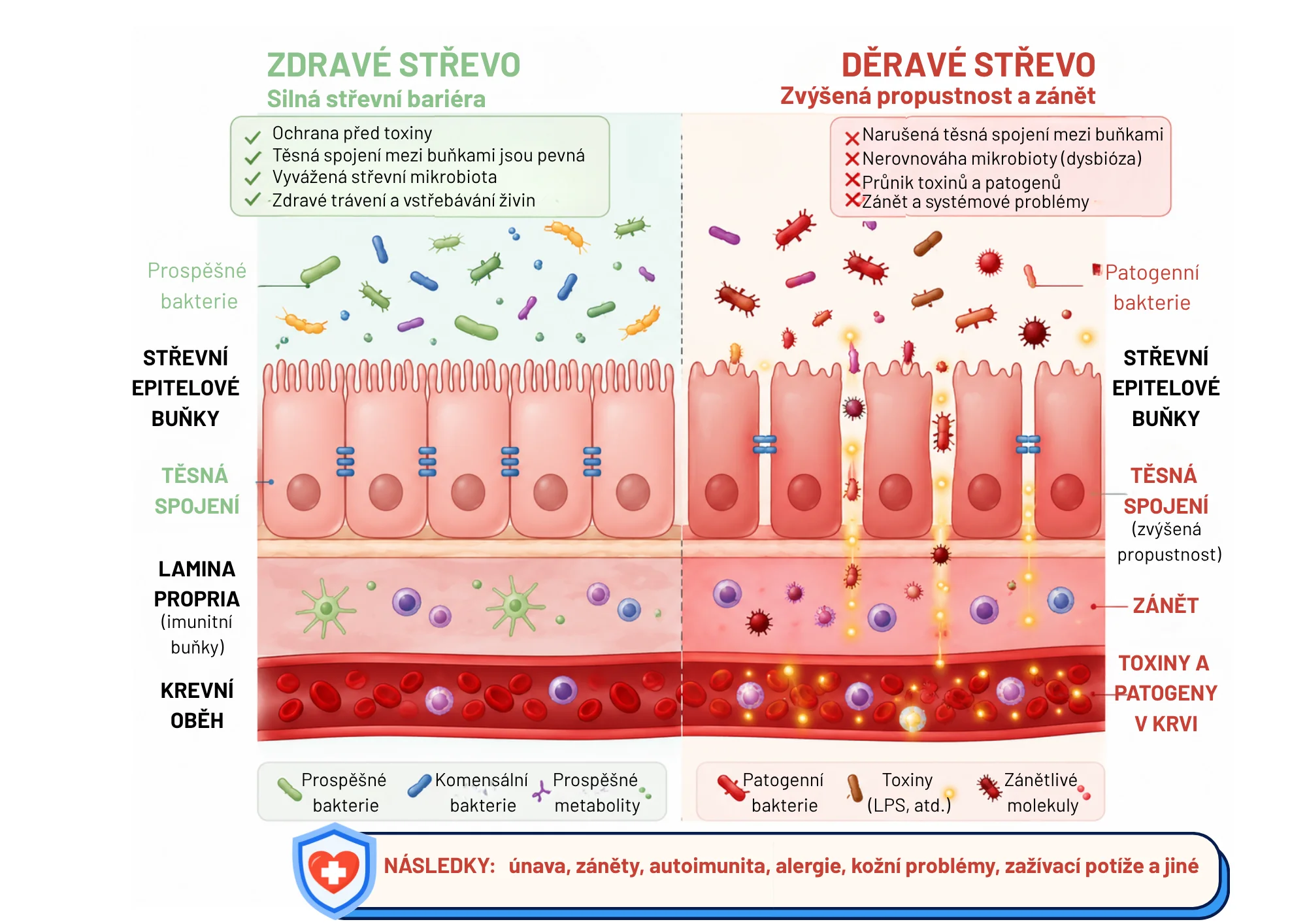 Mechanismus PCOS: střevní dysbióza, zvýšená propustnost střev, systémový zánět a hormonální nerovnováha