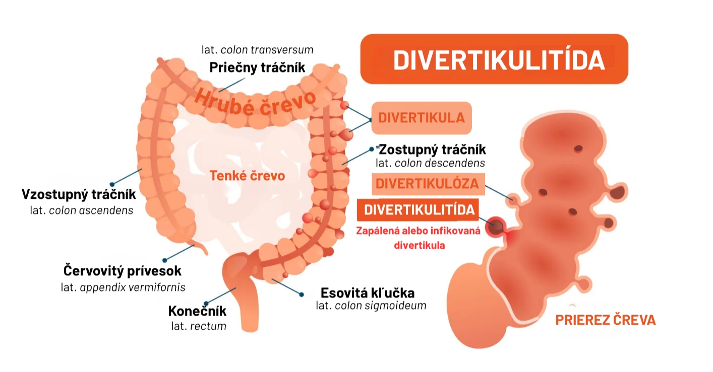 Divertikulitída: Keď v čreve vznikne neželaný zápal.